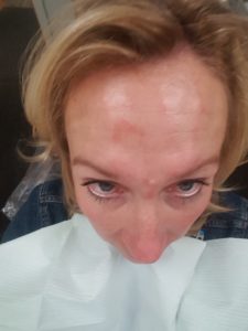 Redness after botox